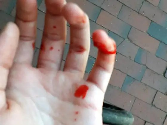 Gebrochener Finger oder Prellung? So erkennen Sie den Bruch